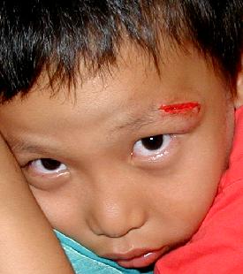 Earnest's Wound